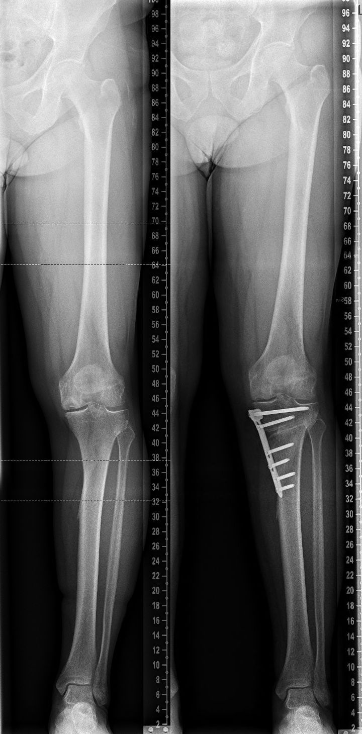 Osteonekroosi saatiin rajoittumaan tekem&auml;ll&auml; valgisoiva osteotomia
